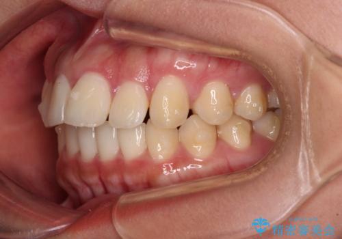 飛び出した上顎前歯 インビザラインで引っ込めるの治療中