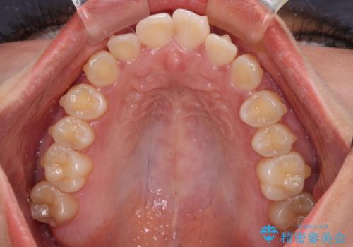 飛び出した上顎前歯 インビザラインで引っ込めるの治療中