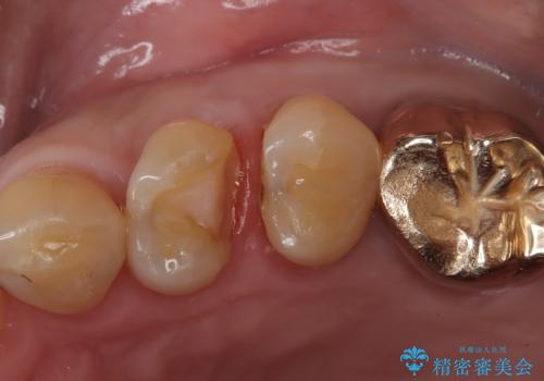 【ゴールドインレー PGA】フロスをしたら銀歯が取れたの治療中