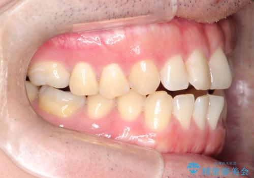 マウスピース矯正で自然な笑顔を実現! 前歯の咬み合わせを治しました。の治療前