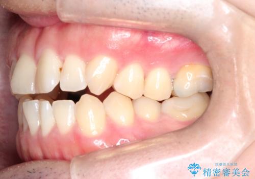 マウスピース矯正で自然な笑顔を実現! 前歯の咬み合わせを治しました。の治療前
