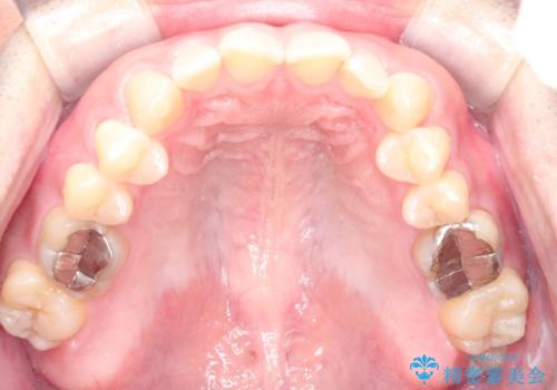 マウスピース矯正で自然な笑顔を実現! 前歯の咬み合わせを治しました。の治療前