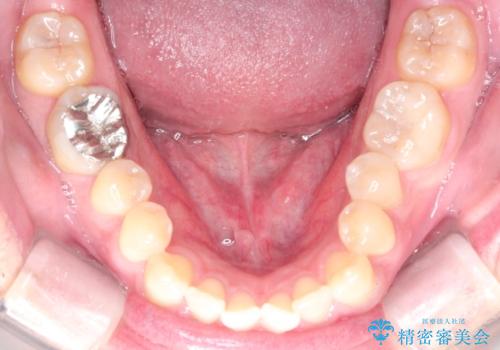 マウスピース矯正で自然な笑顔を実現! 前歯の咬み合わせを治しました。の治療前