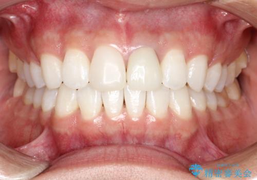 インビザラインによる矯正治療(非抜歯)　下の前歯の歯並びの改善の治療後