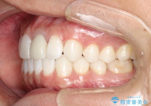 インビザラインによる矯正治療(非抜歯)　下の前歯の歯並びの改善の治療後