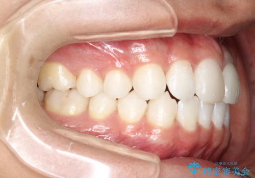 インビザラインによる矯正治療(非抜歯) 下の前歯の歯並びの改善の治療後