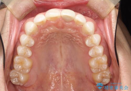 インビザラインによる矯正治療(非抜歯) 下の前歯の歯並びの改善の治療後