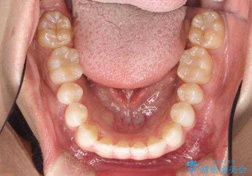 インビザラインによる矯正治療(非抜歯) 下の前歯の歯並びの改善の治療後