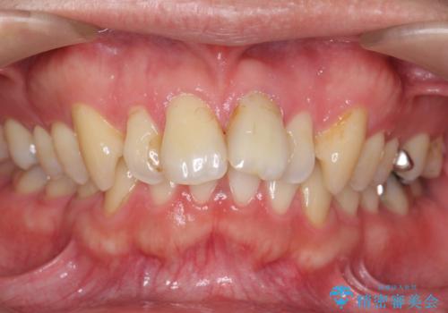 出っ歯を部分矯正で目立たなくする　セラミック治療もの症例 治療前