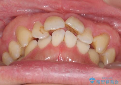 出っ歯を部分矯正で目立たなくする　セラミック治療もの治療前