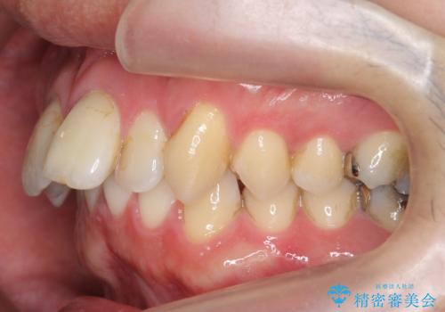 出っ歯を部分矯正で目立たなくする　セラミック治療もの治療前