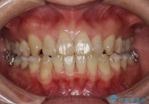 インビザラインによる矯正治療(非抜歯) 前歯の突出と上下の歯並びのガタつきの改善の治療中
