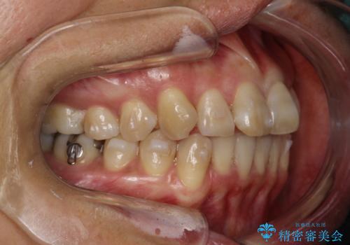 インビザラインによる矯正治療(非抜歯)　前歯の突出と上下の歯並びのガタつきの改善の治療中