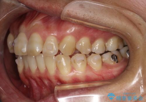 インビザラインによる矯正治療(非抜歯) 前歯の突出と上下の歯並びのガタつきの改善の治療中