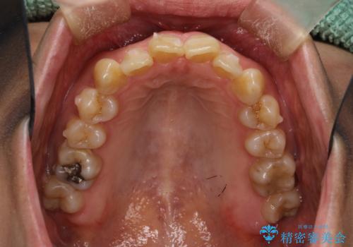 インビザラインによる矯正治療(非抜歯) 前歯の突出と上下の歯並びのガタつきの改善の治療中