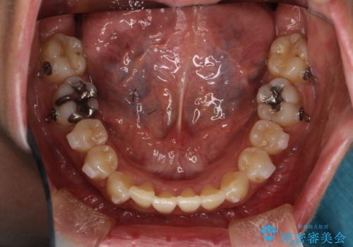 インビザラインによる矯正治療(非抜歯)　前歯の突出と上下の歯並びのガタつきの改善の治療中