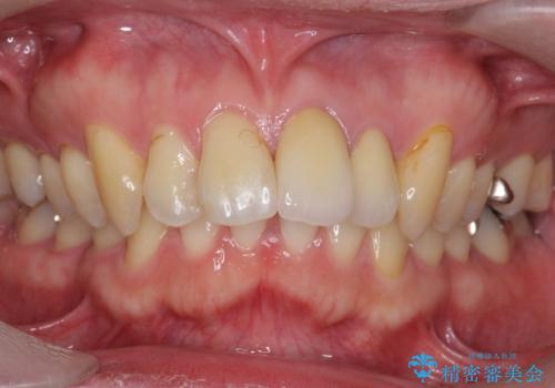 出っ歯を部分矯正で目立たなくする　セラミック治療もの症例 治療後