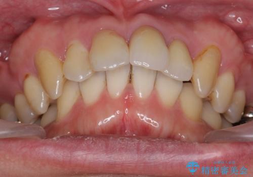 出っ歯を部分矯正で目立たなくする セラミック治療もの治療後