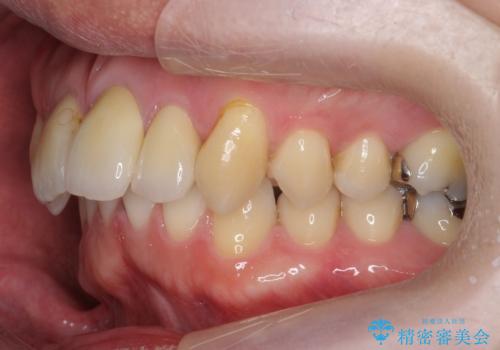 出っ歯を部分矯正で目立たなくする セラミック治療もの治療後