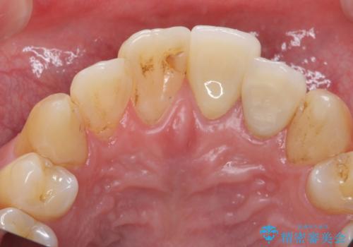 出っ歯を部分矯正で目立たなくする セラミック治療もの治療後