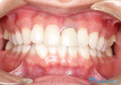 インビザラインによる矯正治療(非抜歯)　下の前歯の歯並びの改善の症例 治療前