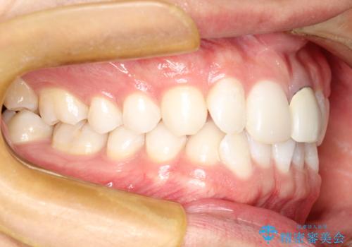 インビザラインによる矯正治療(非抜歯) 下の前歯の歯並びの改善の治療前
