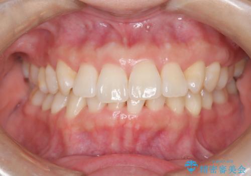 インビザライン ライトパッケージによる部分矯正治療 下の前歯のみの歯並び改善の治療後