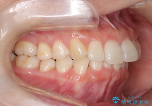 インビザライン ライトパッケージによる部分矯正治療 下の前歯のみの歯並び改善の治療後