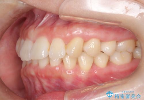 インビザライン ライトパッケージによる部分矯正治療　下の前歯のみの歯並び改善の治療後