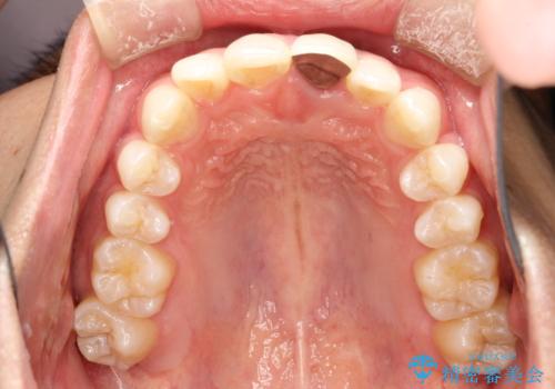 インビザラインによる矯正治療(非抜歯)　下の前歯の歯並びの改善の治療前