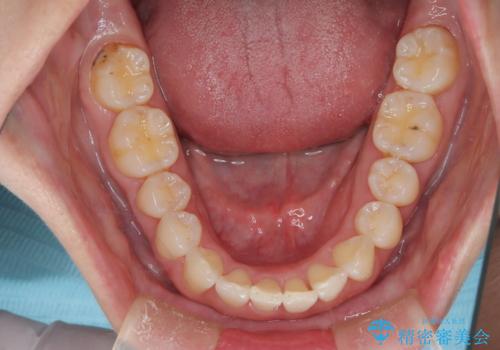 インビザライン ライトパッケージによる部分矯正治療　下の前歯のみの歯並び改善の症例 治療後