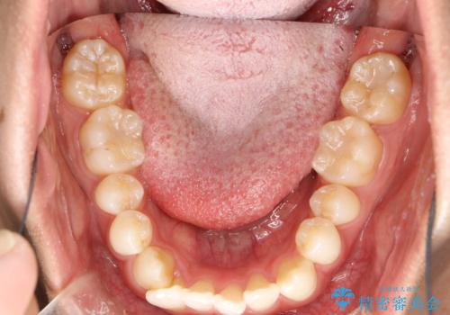インビザラインによる矯正治療(非抜歯)　下の前歯の歯並びの改善の治療前