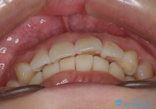 インビザライン ライトパッケージによる部分矯正治療　下の前歯のみの歯並び改善の治療後
