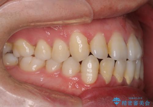 笑顔が魅力的に変わる! インビザライン矯正で前歯のすきっぱを改善しましたの治療前
