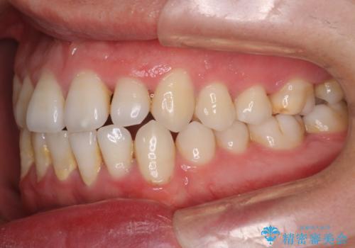 笑顔が魅力的に変わる! インビザライン矯正で前歯のすきっぱを改善しましたの治療前