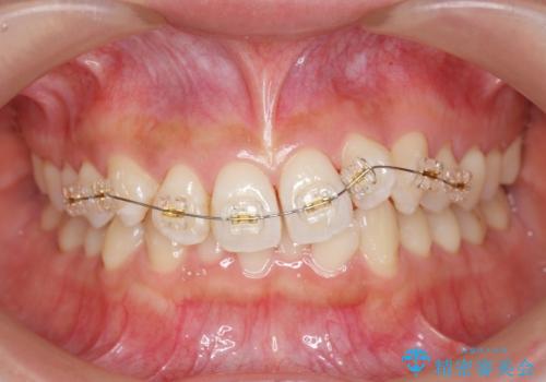 ワイヤー部分矯正治療を併用したマウスピース矯正治療の治療中