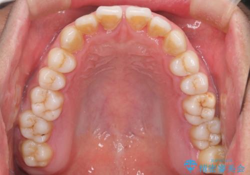 笑顔が魅力的に変わる! インビザライン矯正で前歯のすきっぱを改善しましたの治療前