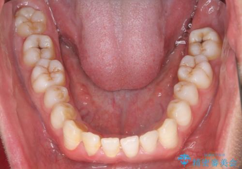 笑顔が魅力的に変わる! インビザライン矯正で前歯のすきっぱを改善しましたの治療前