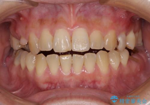 むし歯と咬み合わせで奥歯に負担がかかる　総合歯科治療で悩みを改善の症例 治療前