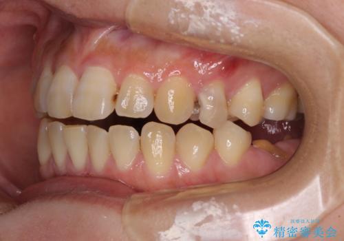 むし歯と咬み合わせで奥歯に負担がかかる　総合歯科治療で悩みを改善の治療前