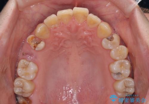 むし歯と咬み合わせで奥歯に負担がかかる　総合歯科治療で悩みを改善の治療前