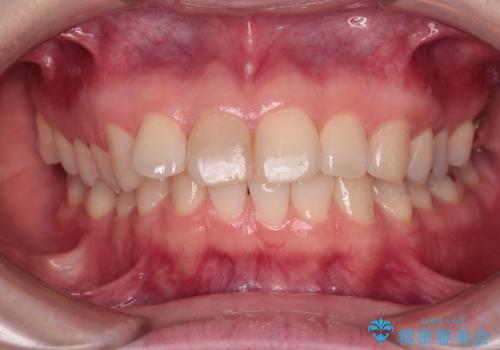 事故でぶつけてから変色した前歯 オールセラミッククラウン補綴治療の治療前