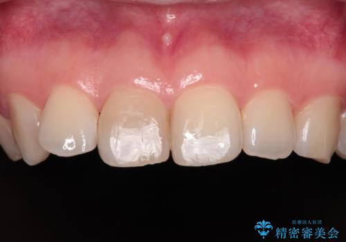 事故でぶつけてから変色した前歯 オールセラミッククラウン補綴治療の症例 治療前