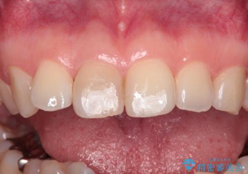 事故でぶつけてから変色した前歯 オールセラミッククラウン補綴治療の治療前