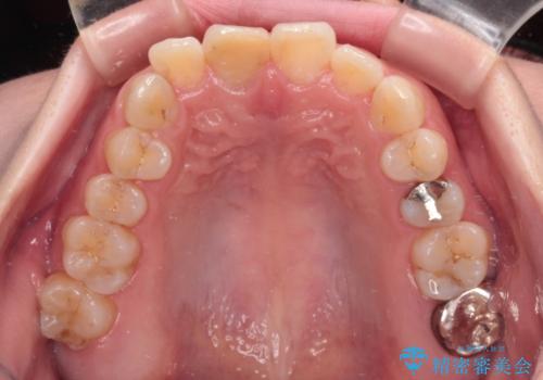 事故でぶつけてから変色した前歯 オールセラミッククラウン補綴治療の治療前