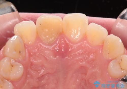 事故でぶつけてから変色した前歯 オールセラミッククラウン補綴治療の治療前