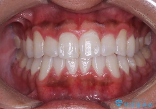 マウスピース矯正で素敵な笑顔に変身!前歯のガタツキを治しましたの治療後