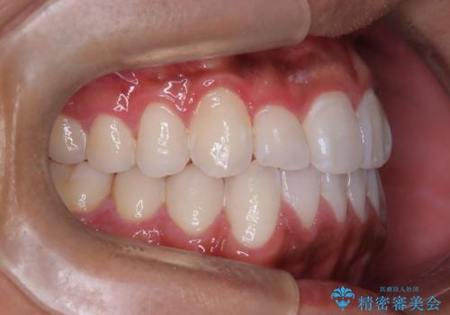 マウスピース矯正で素敵な笑顔に変身!前歯のガタツキを治しましたの治療後