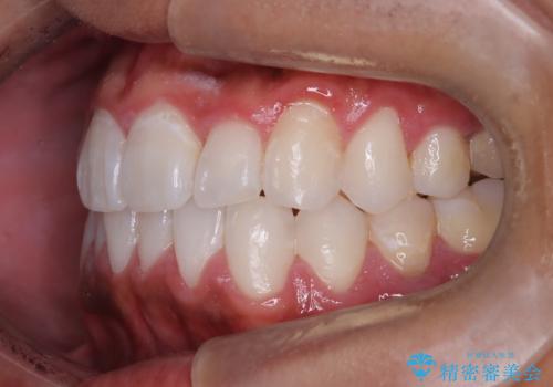 マウスピース矯正で素敵な笑顔に変身!前歯のガタツキを治しましたの治療後