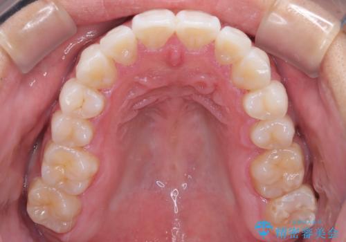 マウスピース矯正で素敵な笑顔に変身!前歯のガタツキを治しましたの治療後